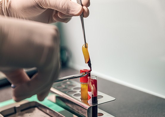 Dentist pulling a membrane out of a vial